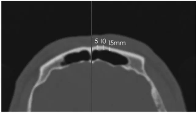 Fig. 1. Axial computed tomography (CT) image of the paranasal  sinuses. The image shows the frontal sinus depth measurements