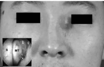 Fig.  1.  The  physical  examination  revealed  a  2  cm×2  cm  fluc- fluc-tuant mass above the left medial canthal area and over the  ethmoid sinus with surrounding cellulitis (inlet; nasal endoscopic  finding).