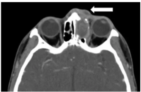 Fig.  2.  Axial  computed  tomogram of  paranasal  sinuses  shows  opacification of the left ethmoid sinus with bone erosion and  swelling of overlying soft tissue and skin (white arrow).