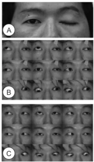Fig.  1.  (A)  The  patient  suffered  from  left  complete  ptosis.  (B)  Composite  photograph  of  eye  movements  1  day   post-oper-atively