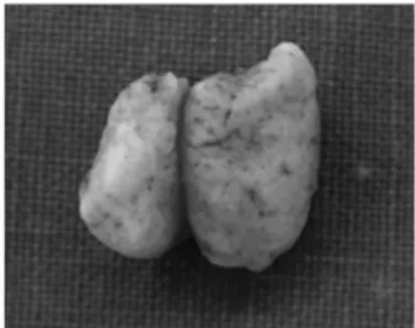 Fig. 2. Well defined, irregular, nodular shaped hard mass, mea- mea-suring 1.3 x 1 cm