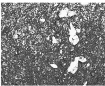 Fig. 1. (B) Preoperative computed tomographic image shows  soft tissue lesion with calcification in left sphenoid sinus