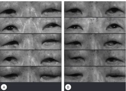 Fig. 7. (A) postoperative 1 month, (B) postoperative  3 months. The patients had medial gaze limitation  of the left eye, which had improved at  postopera-tive 3 months