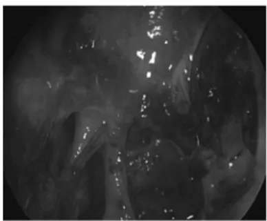 Fig. 5. Postoperative endoscopic finding. No evidence of recur- recur-rence of osteoma and clear mucosal lining in nasal cavity.