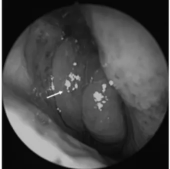 Fig. 1. Case 1. Endoscopic view of REAH in the right nasal cav- cav-ity:  The  mass  was  tan-white  in  color,  elastic  and  hard,  with  a  smooth surface.
