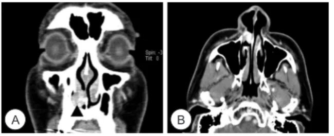Fig. 5. Microscopic features of the tumor. Typical fibrosis(in oval  area)  and  vessels  without  anastomosing  are  seen