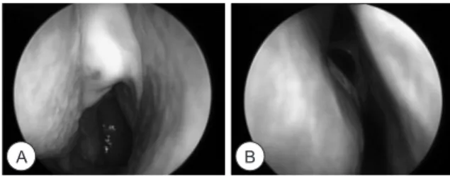 Fig. 1. Endoscopic view of right nasal cavity at first visit.  