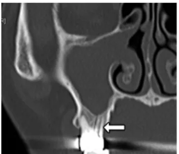 Fig. 4. Gutta-Percha cone that was removed during the opera- opera-tion (top), and an unused Gutta- Percha cone (botom)