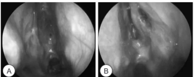 Fig. 2. Coronal OMU CT of Turbinates dysgenesis. Poorly devel- devel-oped ethomoidal cells and absence of both turbinates.