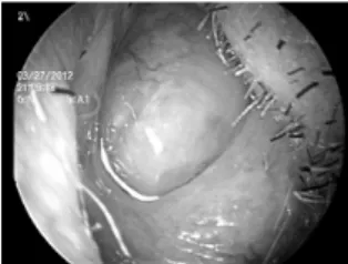 Fig. 1. The preoperative endo- endo-scopic finding : pinkish colored  round  shaped  polypoid  mass  was filled with nasal cavity.
