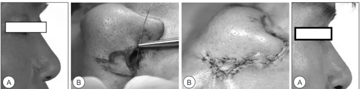 Fig. 1. A. Preoperative profile view shows the scar at the nasal alar which was made by the previous surgery (excision of the nasal alar  skin tumor and reconstruction with the local advanced flap at other hospital)