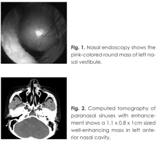 Fig. 1. Nasal endoscopy shows the  pink-colored round mass of left  na-sal vestibule.
