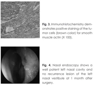 Fig. 3. Immunohistochemistry dem- dem-onstrates positive staining of the  tu-mor cells (brown color) for smooth  muscle actin (X 100).