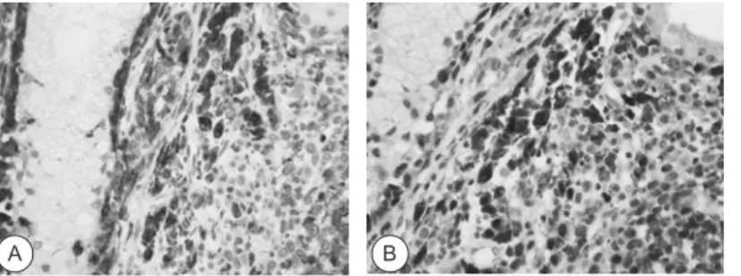 Fig.  3.  black-yellowish  mass  was  found at the ostium of right  sphe-noid sinus. 