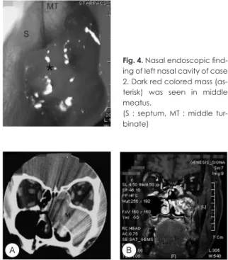 Fig. 1. Preoperative coronal CT  of case 1 scan shows a large  soft tissue mass filled the right  maxillary sinus with associated  expansion  of  the  sinus