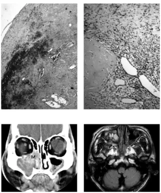 Fig. 6. Microscopic view of organizing hematoma of case 2 showing  old hematoma with proliferation of neovascularization