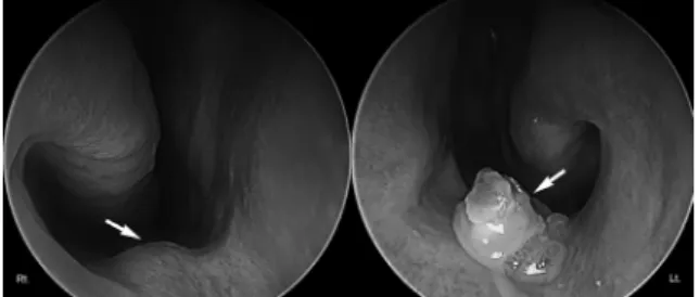 Figure  1.  Nasal  endoscope  showed  elevated  nasal  floor  mu- mu-cosa in the right nasal cavity and whitish encrusted mass in the  left nasal cavity (white arrows).