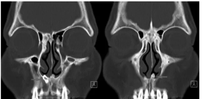 Figure 2. Coronal computed tomography of the paranasal si- si-nuses  revealed  bilateral  nasal  supernumerary  teeth  erupted  from nasal floor (red arrows).