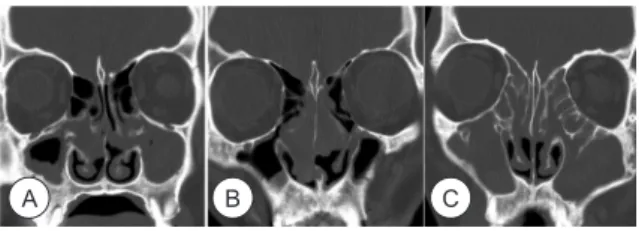 Fig. 1. Position of the Crista galli noted by relation to the cribri- cribri-form plate