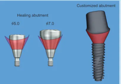 Fig.  18. 	 Difference	 between	 round-shape	 healing	 abutments	 and	 individualized	 subgingival	 contour	 of	 computer	aided	design/computer	aided	manufacturing	 (CAD/CAM)	abutment.