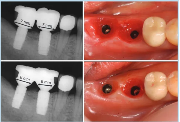Fig. 14. 	Abutments	with	too-wide	  emergence	angle	have	caused	peri-implantitis	 (By	 courtesy	 of	 Sung	 Moo-Gyung).