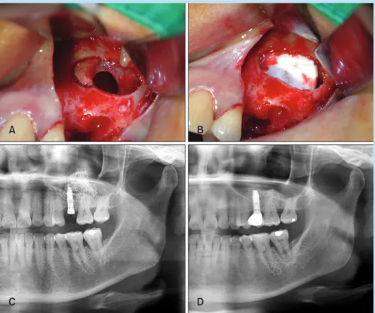 Fig. 1. 	(A)	An	accessory	window	 was	prepared	next	to	the	membrane	 tear	site.	(B)	The	sinus	membrane	 was	lifted,	and	the	perforation	area	 was	 covered	 with	 collagen	 membrane.	 (C)	 Post-operative	 panoramic	view:	dome-shaped	sinus	 grafting	can	be	s