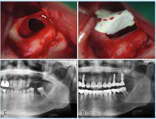 Fig. 2. 	(A)	An	intact	sinus	membrane	 along	the	extended	bony	window	can	 be	seen.	(B)	Collagen	membrane	was	 inserted	 beneath	 the	 lifted	 sinus	 membrane.	 (C)	 Pre-operative	 panoramic	view:	the	edentulous	ridge	 area	of	the	upper	left	posterior	regi
