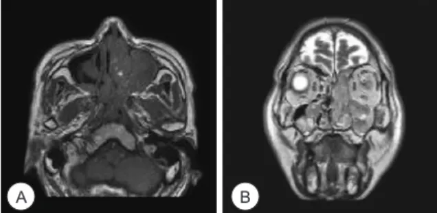 Fig. 3. (A) T1 axial and (B) T2 coronal view of MRI. The mass had  intermediate signal intensity with less enhancement, which was  similar to nasal polyposis.