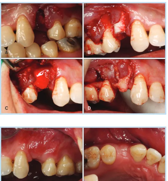 Fig. 14. 	Three	months	after	ridge	 preservation.	 The	 site	 healed	 uneventfully.