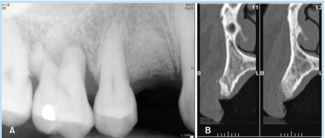 Fig. 17. 	Two	weeks	after	implant	 installation.