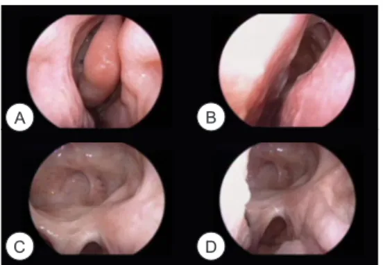 Fig.  5.  A  postoperative  endoscopic  examination  showing  no  evidence of tumor recurrence (27 months after 2nd operation)