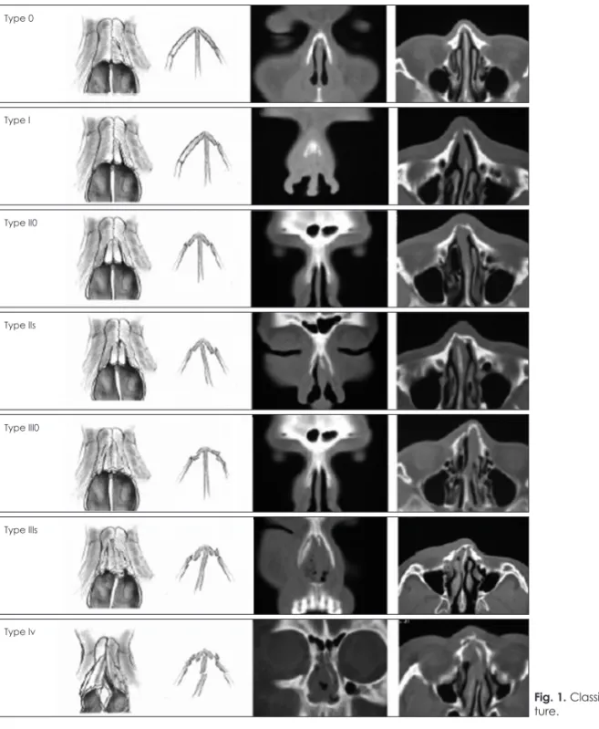 Fig. 1. Classification of nasal bone frac- frac-ture.Type 0Type lType ll0Type llsType lll0Type lllsType lv