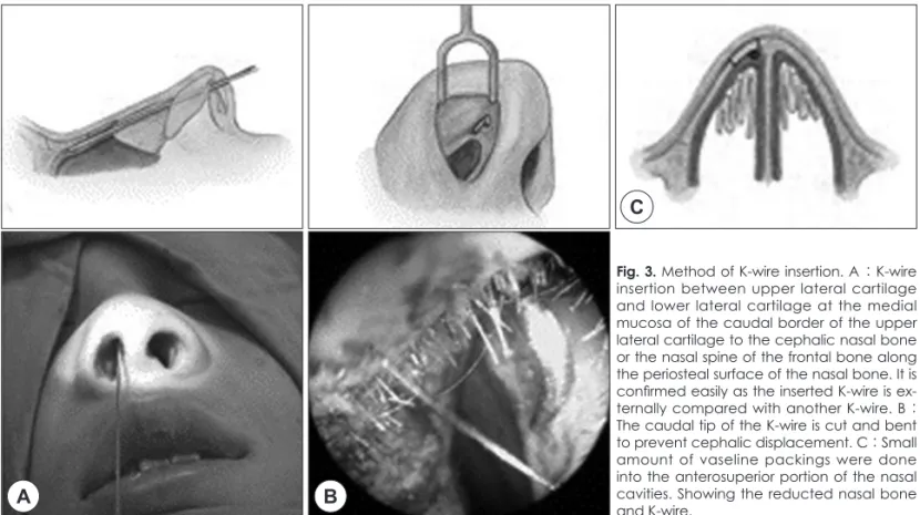Fig. 3. Method of K-wire insertion. A : K-wire  insertion between upper lateral cartilage  and lower lateral cartilage at the medial  mucosa of the caudal border of the upper  lateral cartilage to the cephalic nasal bone  or the nasal spine of the frontal 
