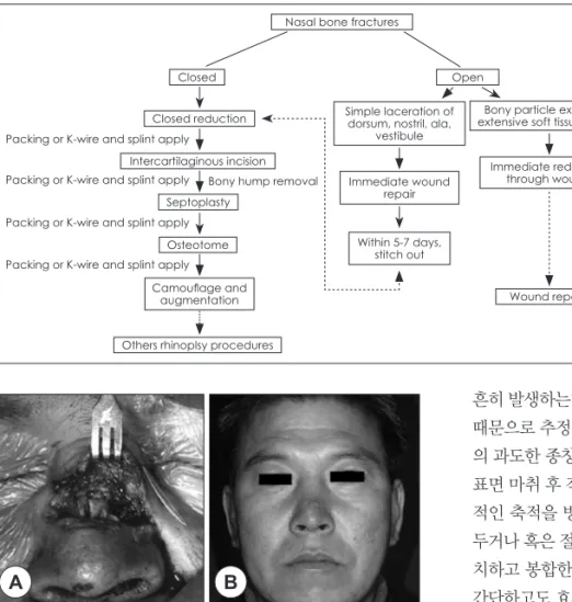 Fig. 6. Management for nasal bone  fracture.