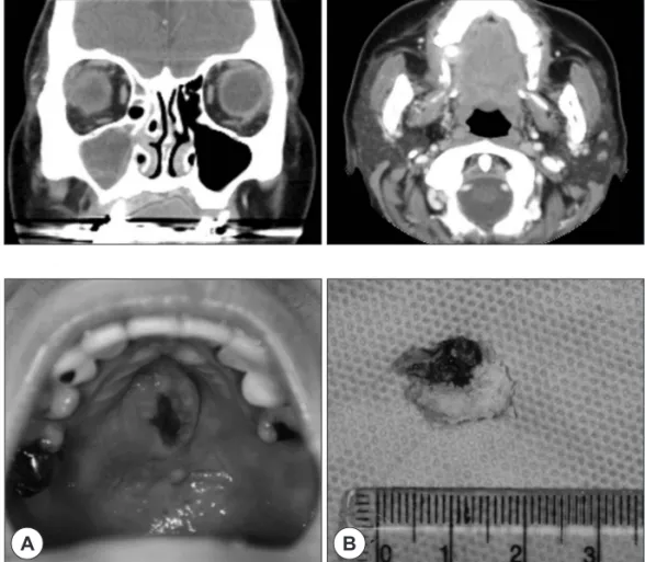 Fig. 2. Paranasal sinus computed to- to-mography showed soft tissue density in  the right maxillary sinus