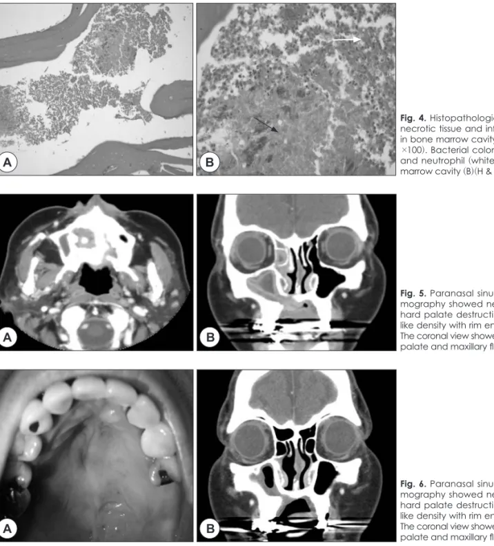 Fig. 4. Histopathologic study showed   necrotic tissue and inflammatory cells  in bone marrow cavity (A)(H &amp; E stain, 