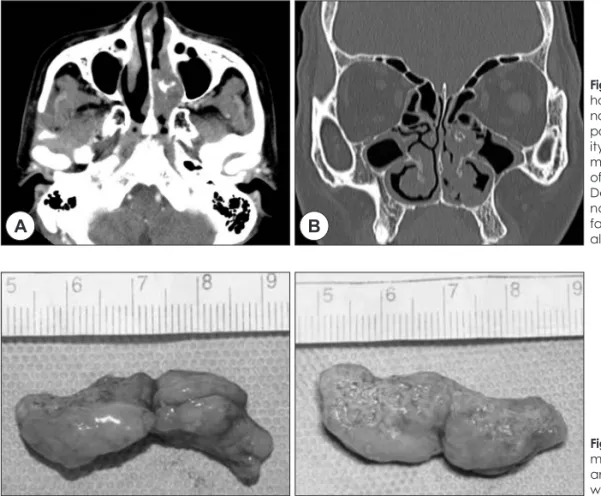 Fig. 3. Surgical specimen. The soft tissue  mass was 40×15×12 mm sized, polypoid  and yellowish brown color