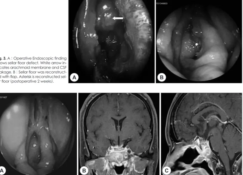 Fig. 3. A : Operative Endoscopic finding  shows sellar floor defect. White arrow  in-dicates arachmoid membrane and CSF  leakage