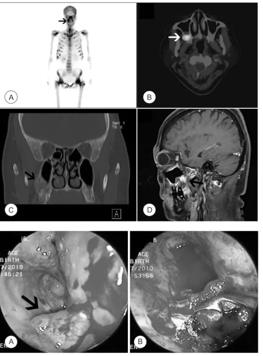 Fig. 1. A. Whole body bone  scan  showing  multiple  pathologic  fracture  foci. 