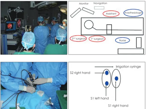 Fig. 1. The operating room setup. The  surgeons are positioned on the right  side of the patient opposite the  anes-thesia team