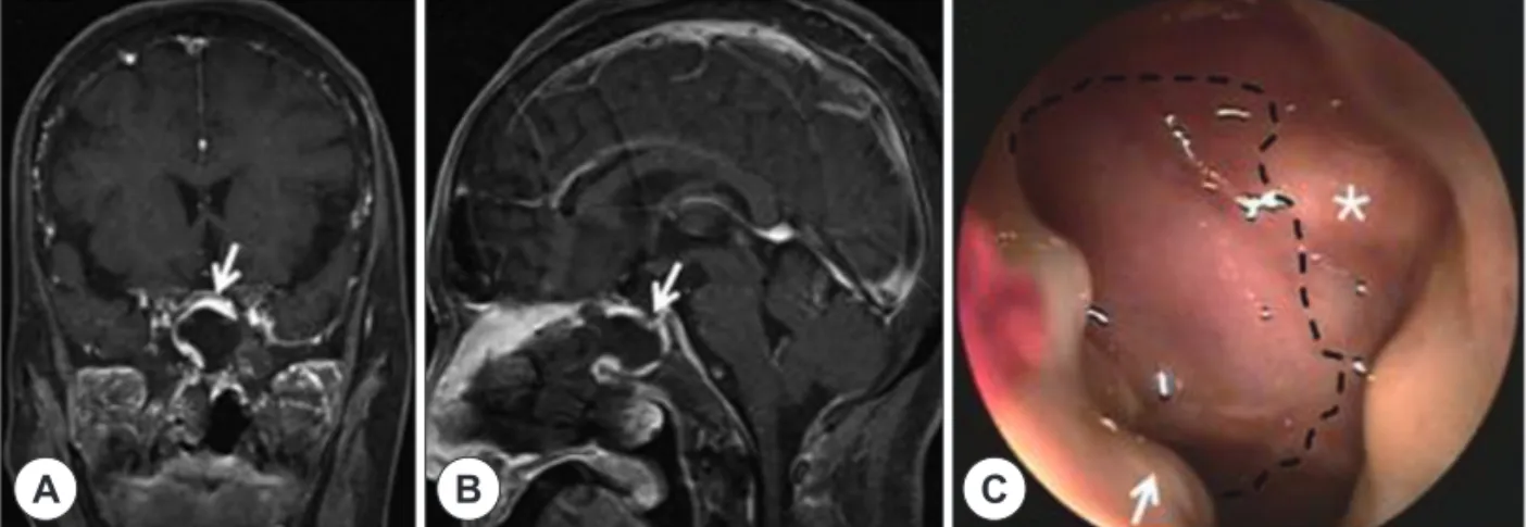 Fig. 3. Representative postoperative MR and endoscopic images after endoscopic endonasal transsphenoidal hypophysectomy