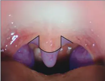 Fig. 1. Operation technique of radiofrequency-assisted uvulo- uvulo-palatoplasty (RAUP) with tonsillectomy