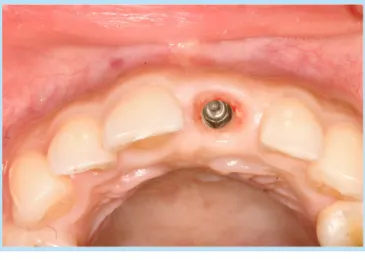 Fig. 4. 	Postoperative	healing	view	after	8	weeks.