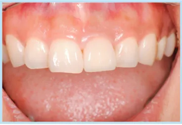 Fig. 8. 	Follow	up	result	after	3	years	6	months	of	function.