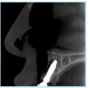 Fig.  10. 	 Preoperative	 periapical	 radiograph.	 Note	 interproximal	bone	loss	in	distal	side.