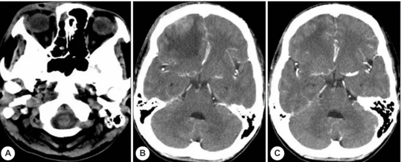 Fig. 5. Postoperative CT scans. Subperiosteal space was normalized except for the fact that air shadow was observed (A)