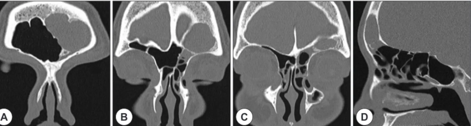 Fig. 1. Preoperative CT images. Coronal CT images (A-C) show frontal sinusitis which is located superolateral portion and Sagittal CT im- im-age (D) shows the deeply developed frontoethmoidal air cell which is narrowing the frontal recess.