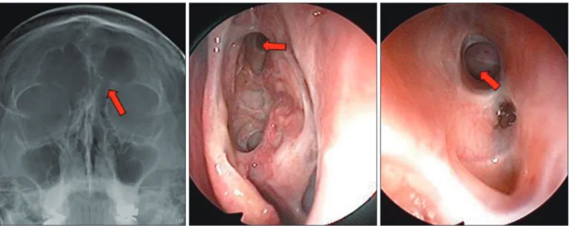 Fig. 3. Operative finding matched with CT. We perforate the roof of frontoethmoid air cell (white arrows) after identifying the sagittal CT  scan (A-C) After perforation, we insert the designed K-wire at the site of perforation (yellow arrow) to remove the