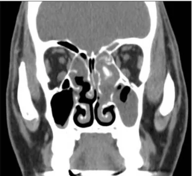Fig. 1. Chronic inflammation and calcification in paranasal sinus  due to remained Merocel.