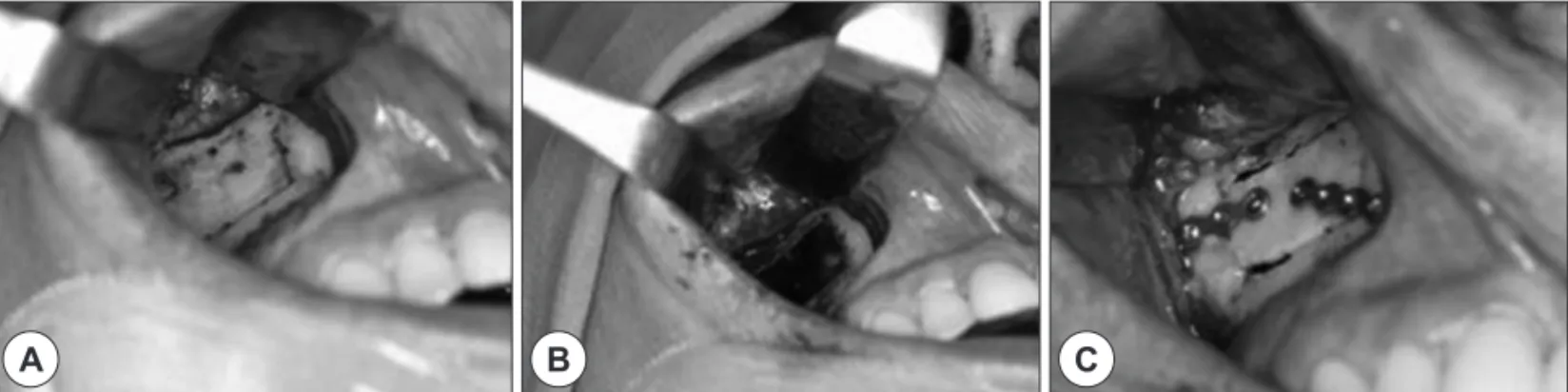 Fig. 1. Intraoperative view showing an 2×1 cm rectangular flap designed on the anterior wall of the maxillary sinus (A)